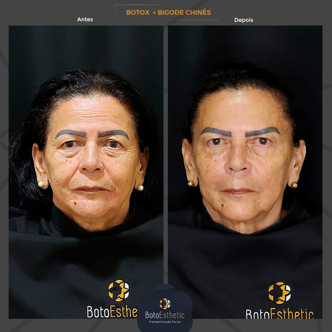 BE-Botox-1.jpg