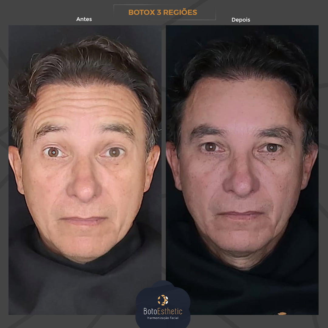 BE-Botox-2.jpg