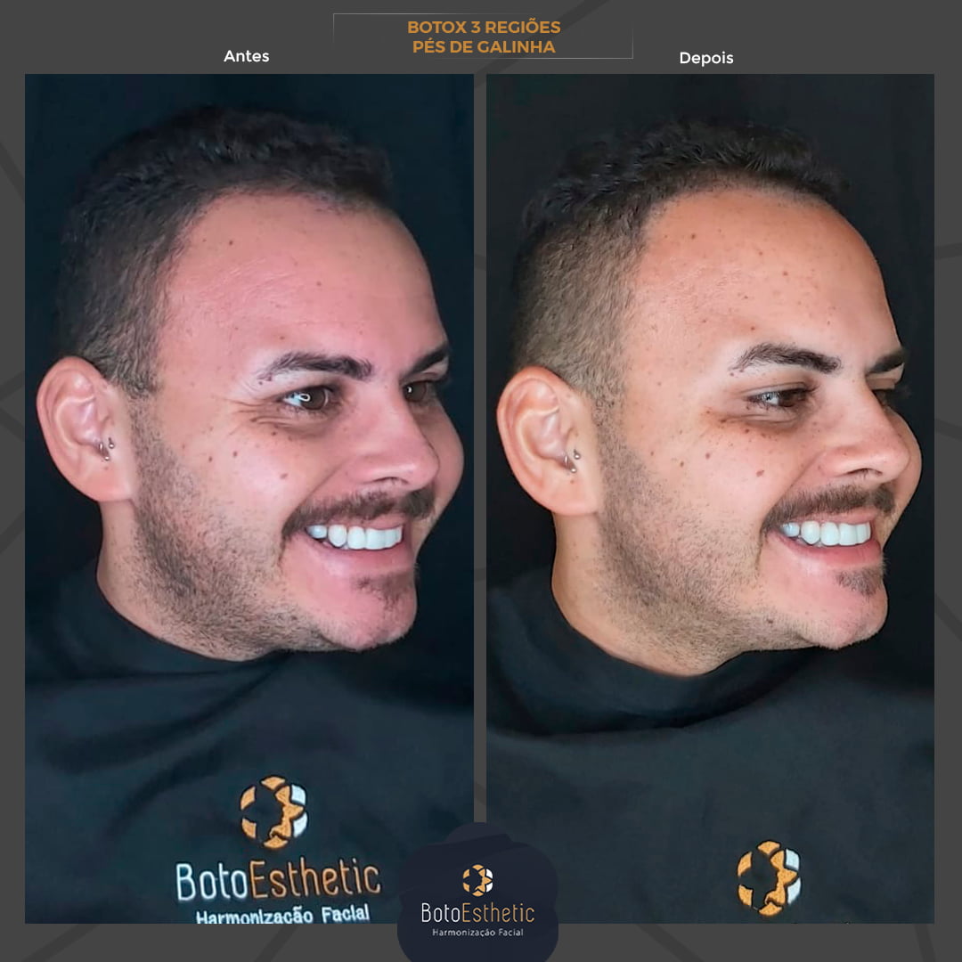 BE-Botox-4.jpg