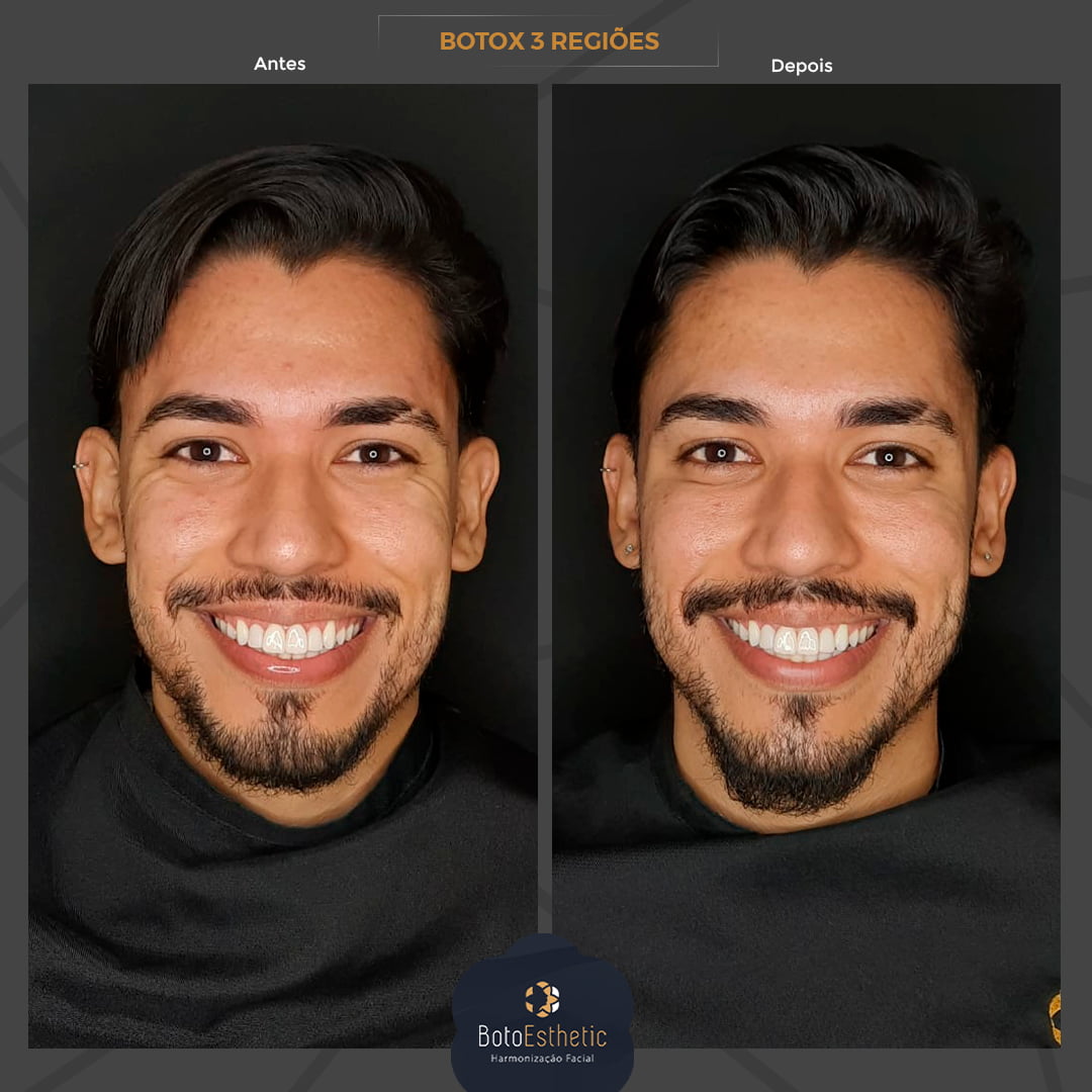 BE-Botox-5.jpg