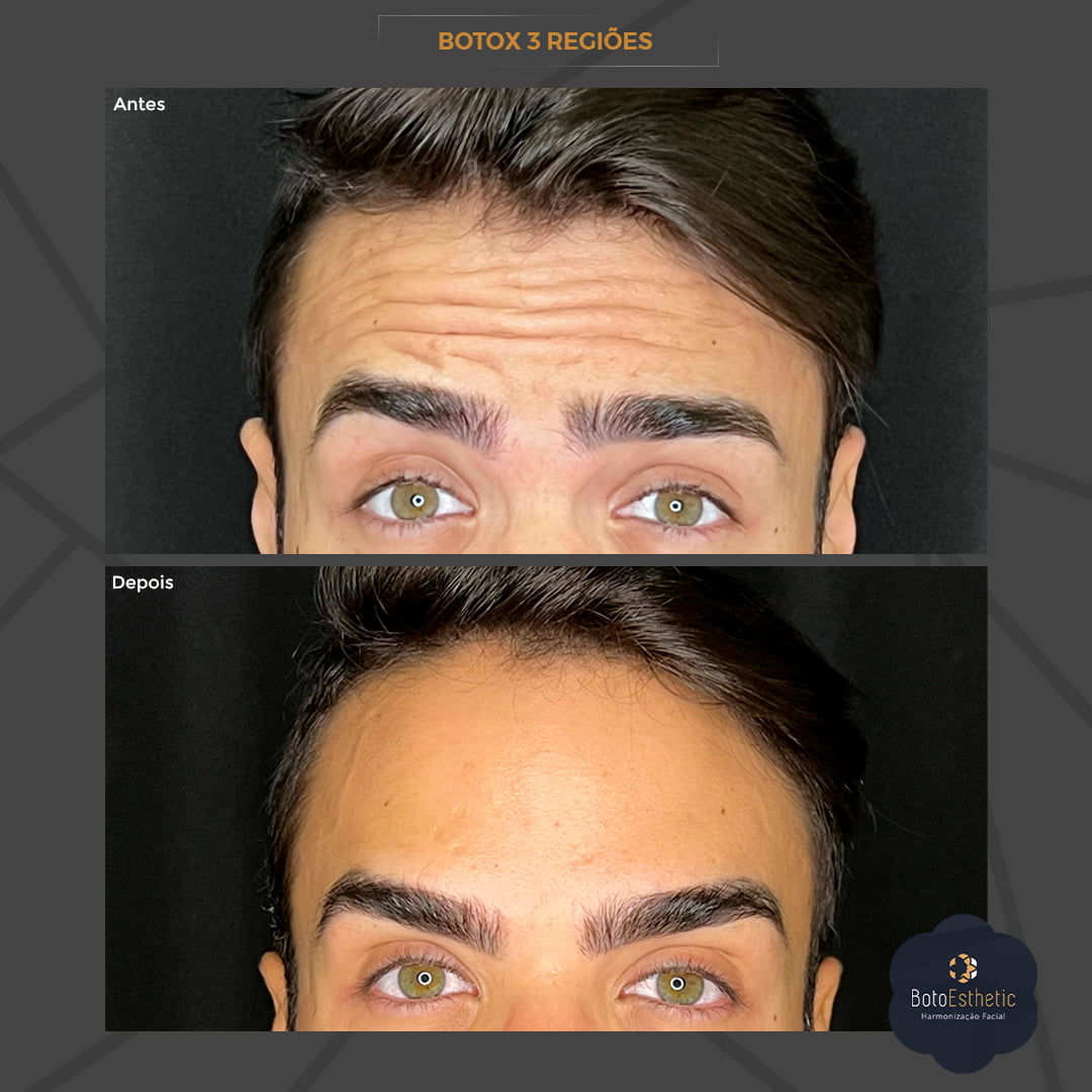 BE-Botox-6.jpg