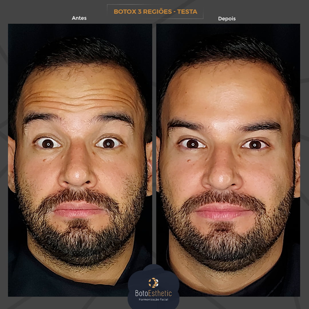 BE-Botox-7.jpg
