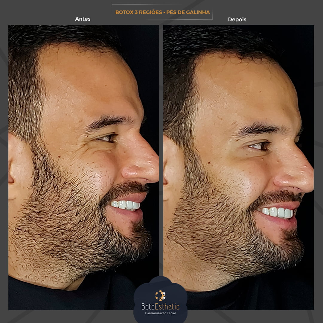 BE-Botox-8.jpg