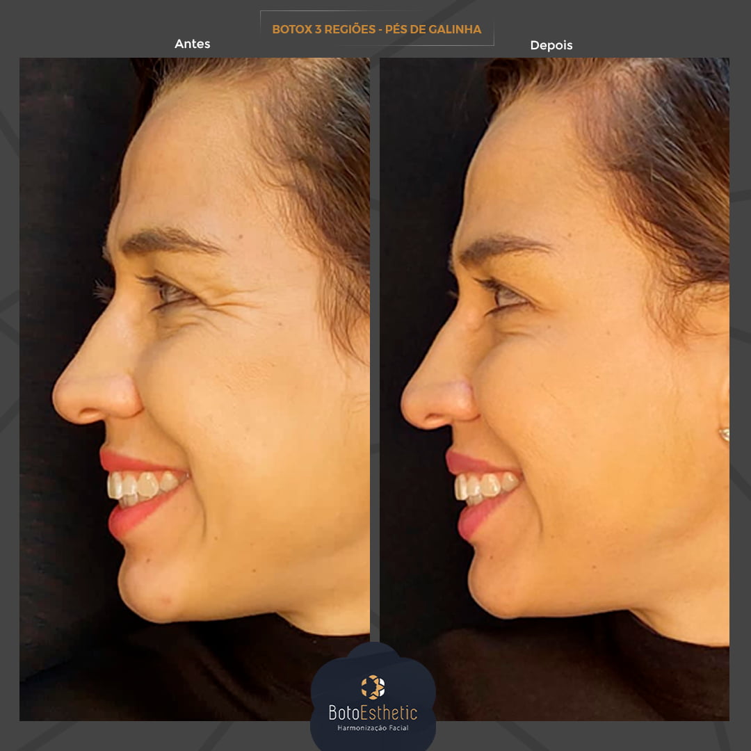 BE-Botox-9.jpg