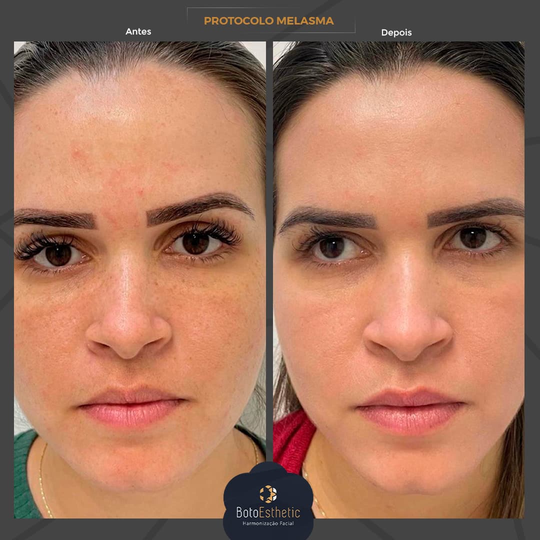 BE-Melasma-1.jpg