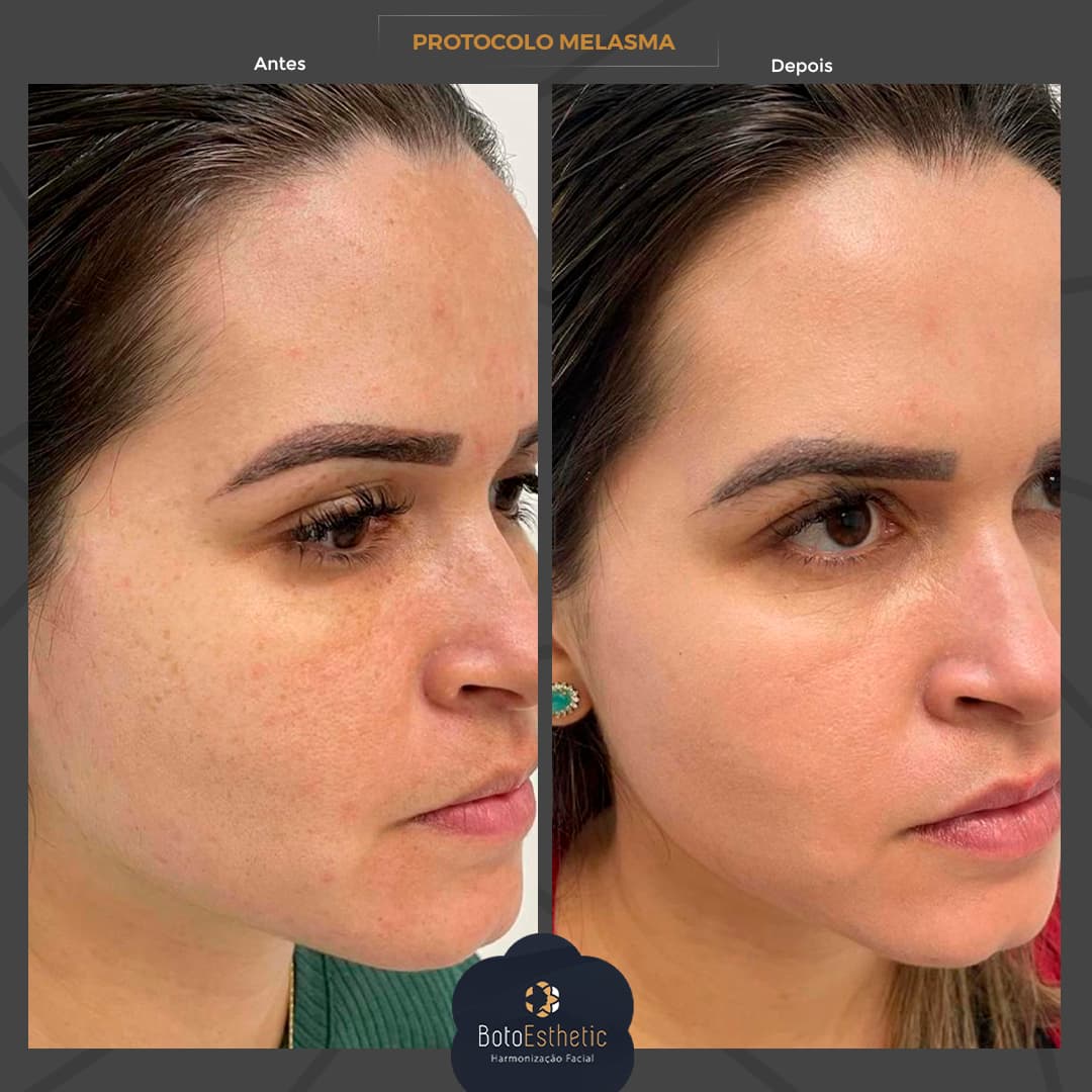BE-Melasma-2-1.jpg