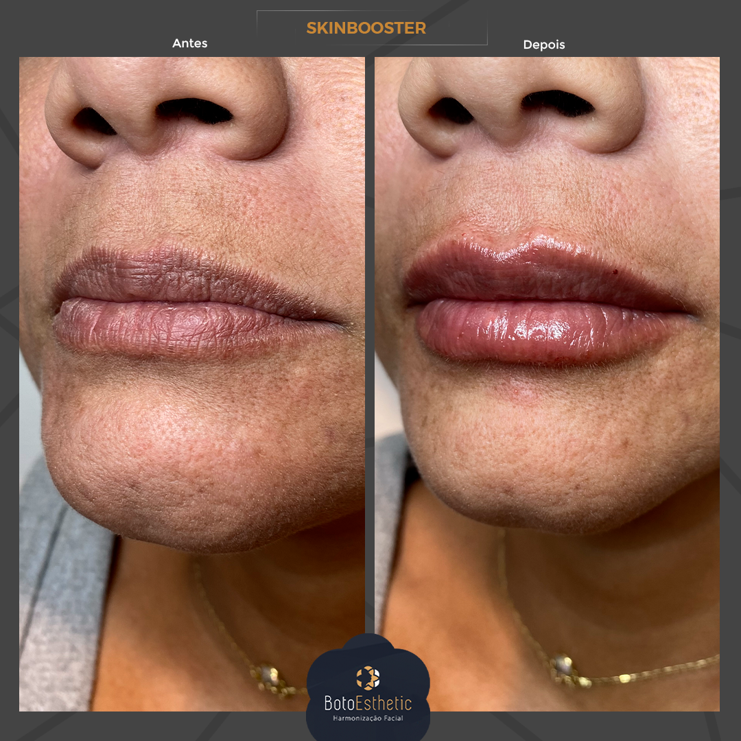 BE-Skinbooster-2.png