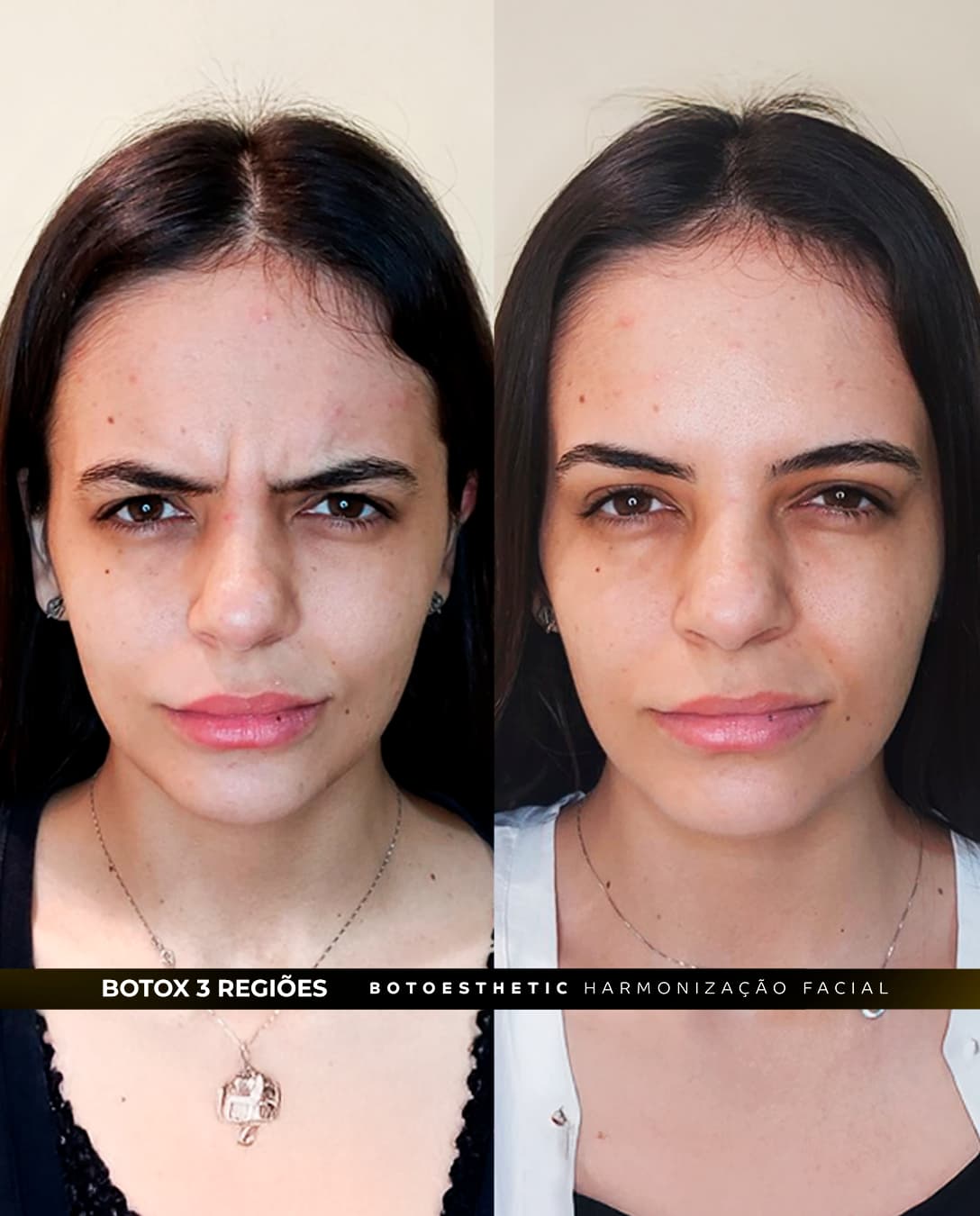 BOTOX GLABELA