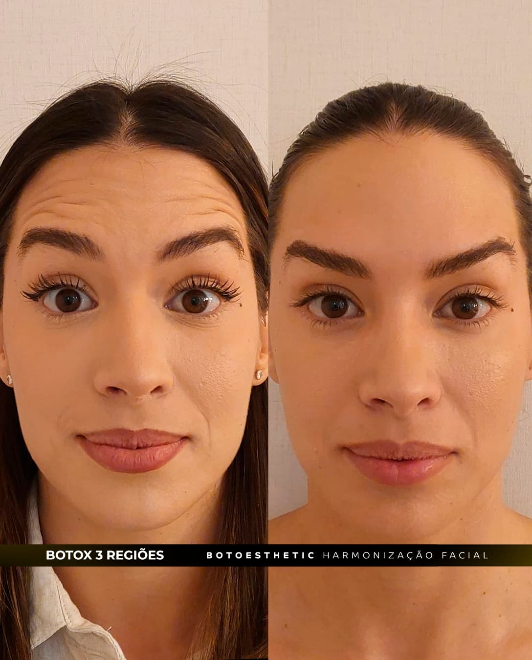 Botox 1