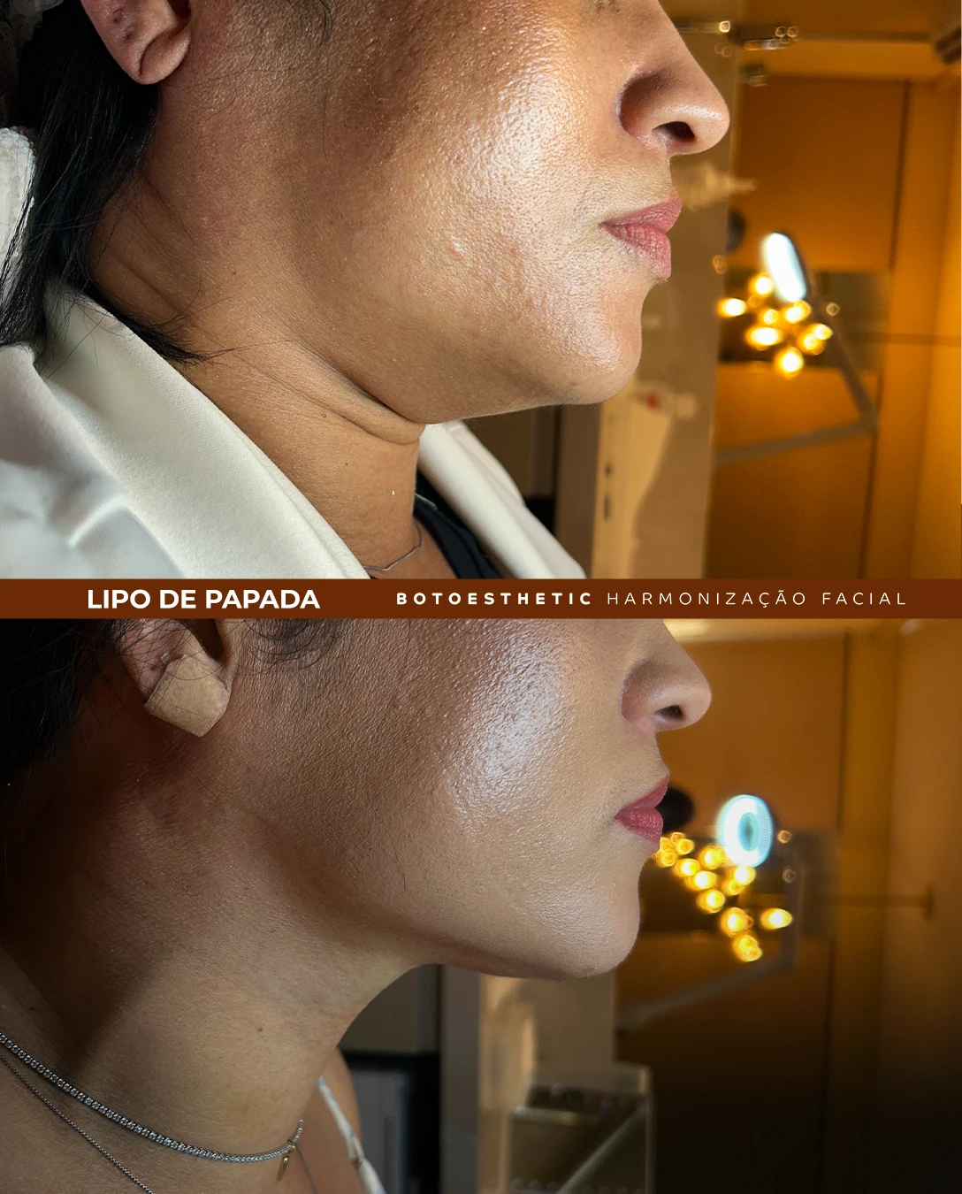 Lipo de papada