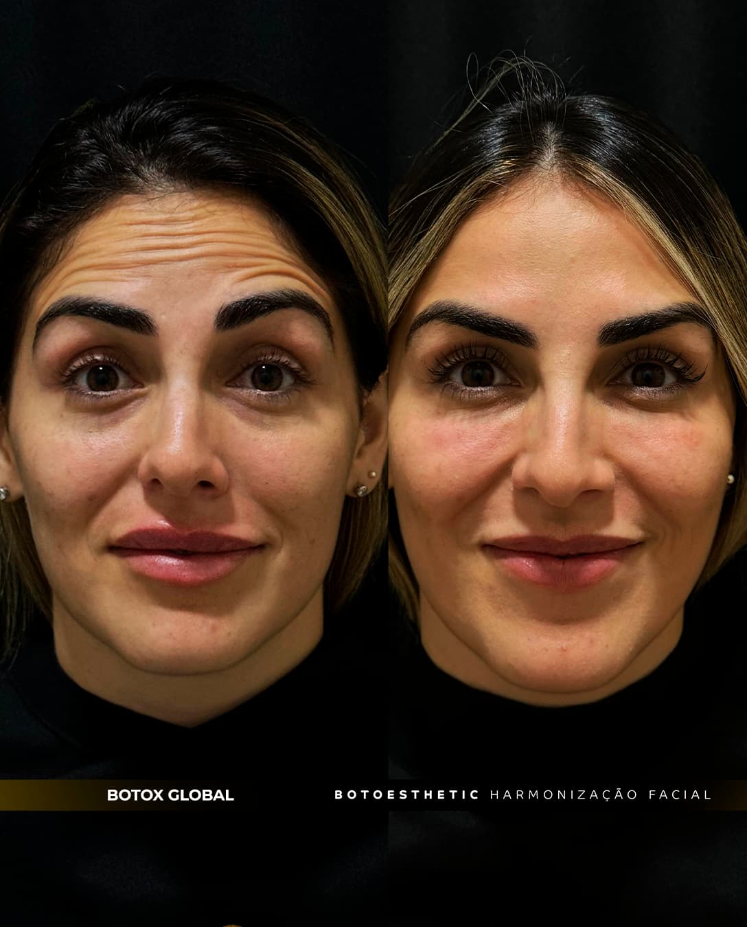 botox global 1