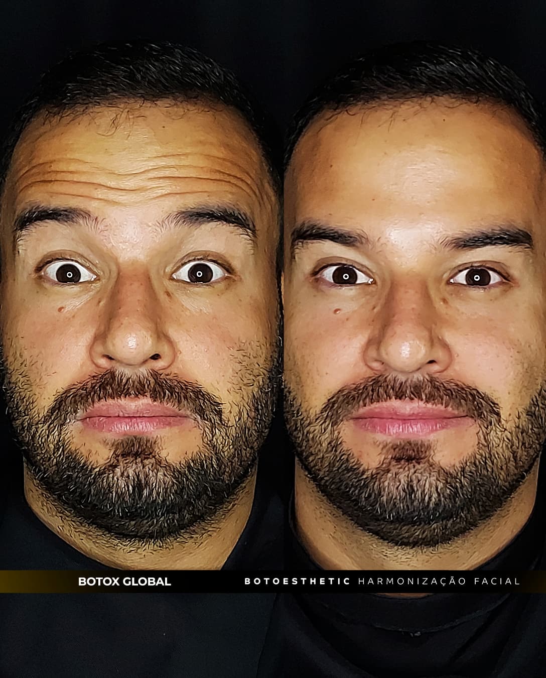 botox global 5
