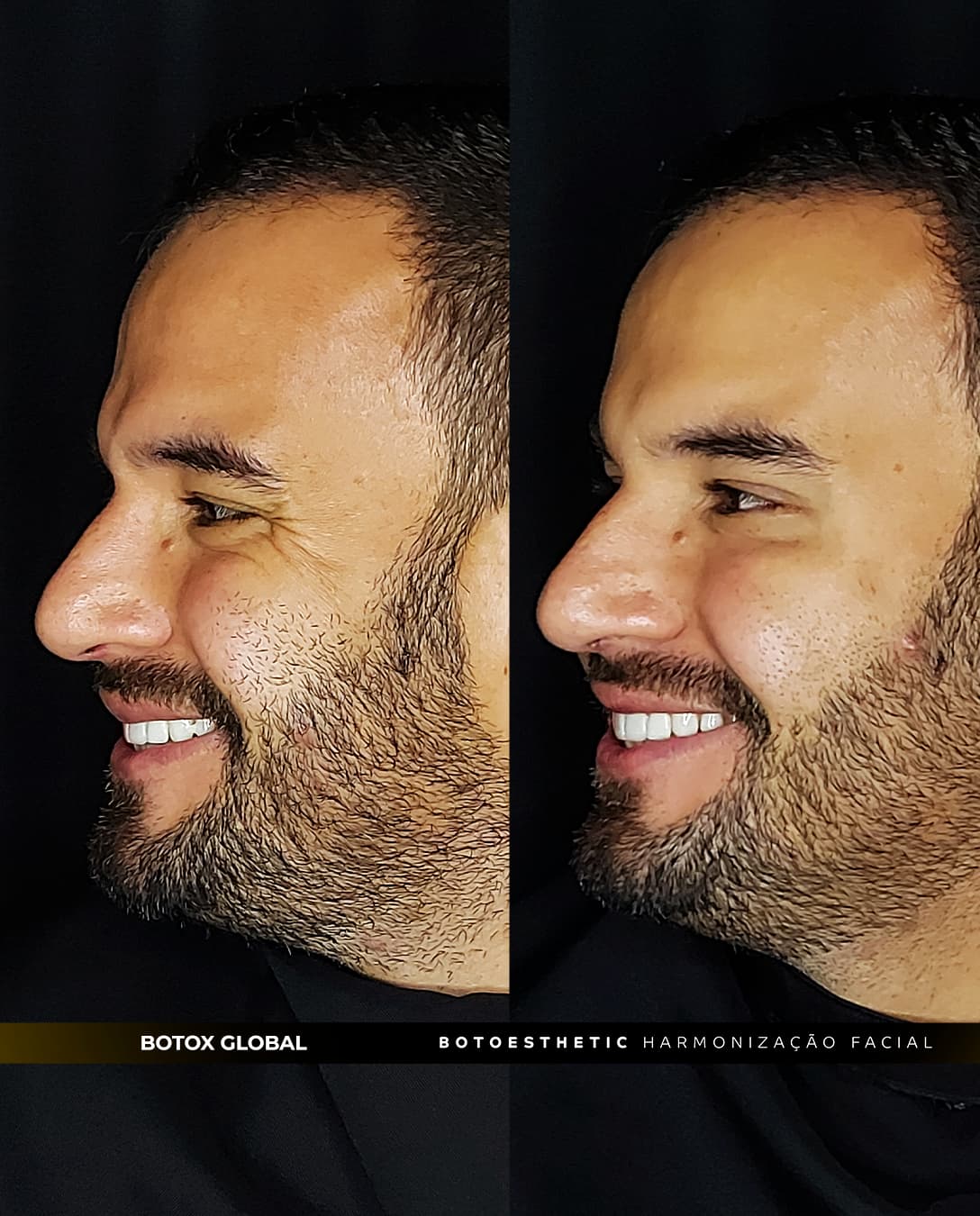 botox global 6